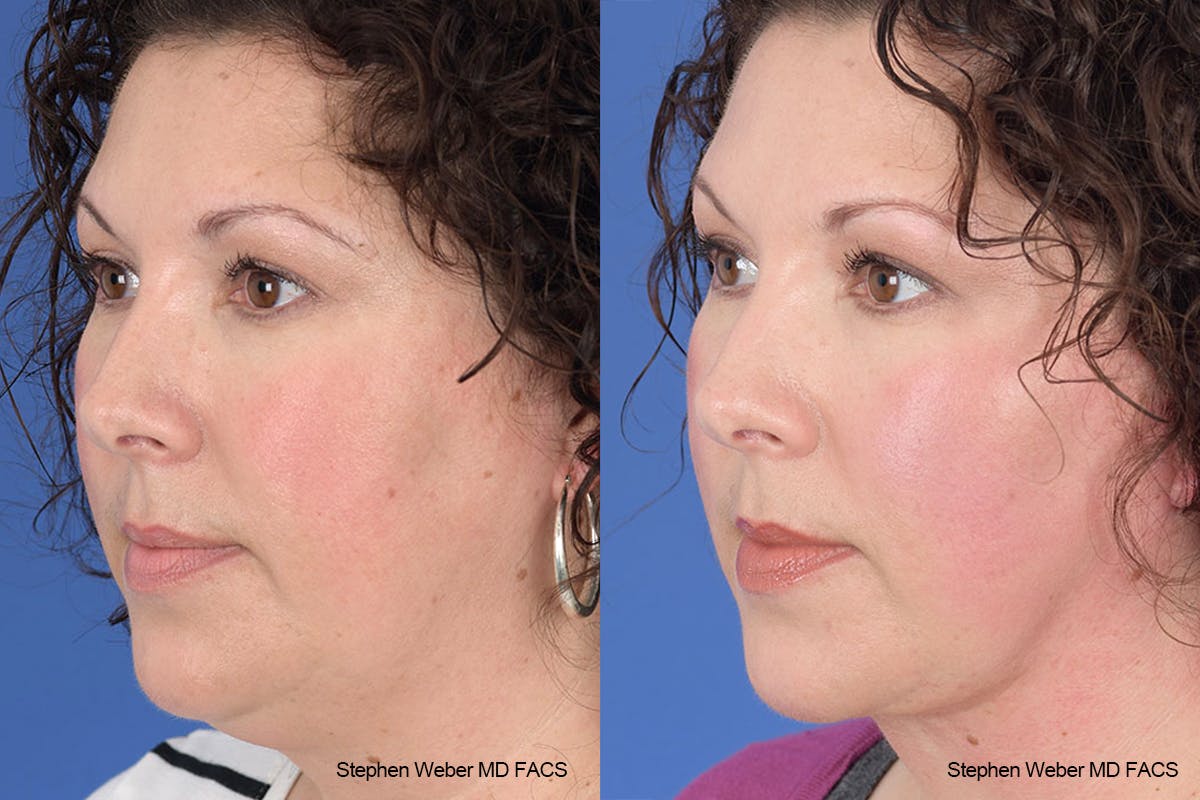 Necklift Before & After Gallery - Patient 883338 - Image 3