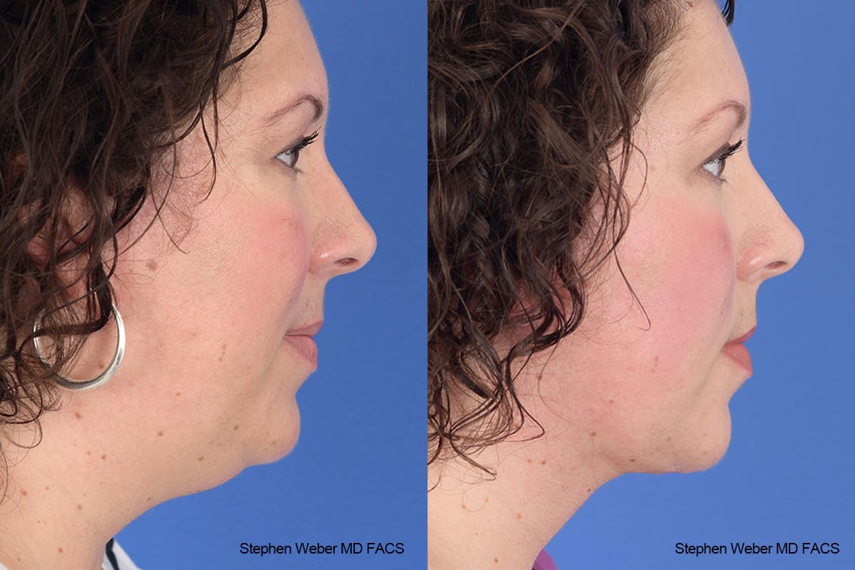 Necklift Before & After Gallery - Patient 883338 - Image 4