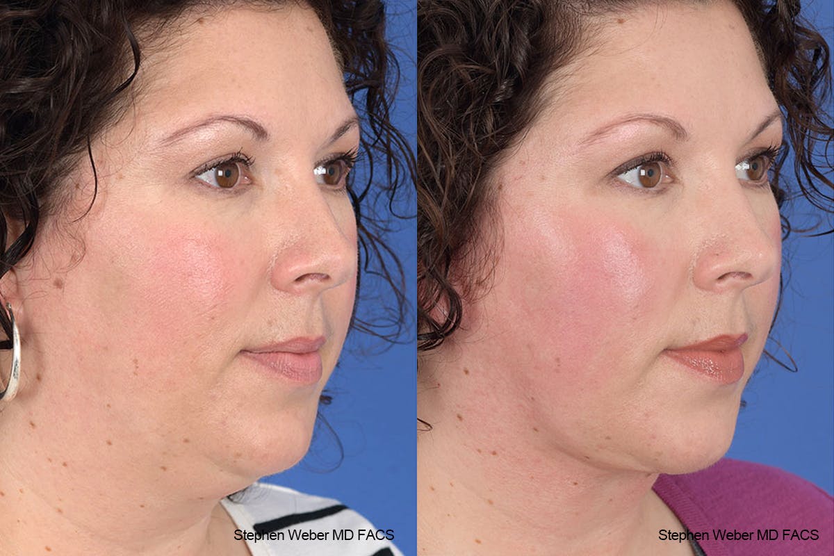 Necklift Before & After Gallery - Patient 883338 - Image 5
