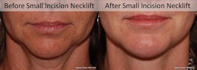 Necklift Before & After Gallery - Patient 400464 - Image 1