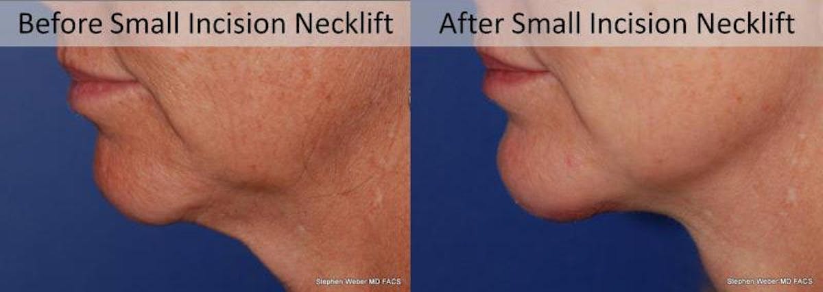 Necklift Before & After Gallery - Patient 400464 - Image 2