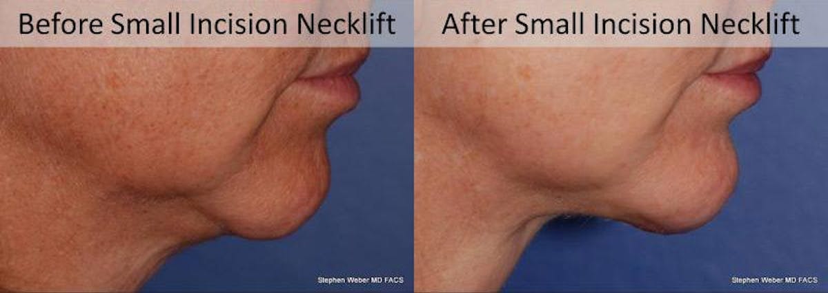 Necklift Before & After Gallery - Patient 400464 - Image 3