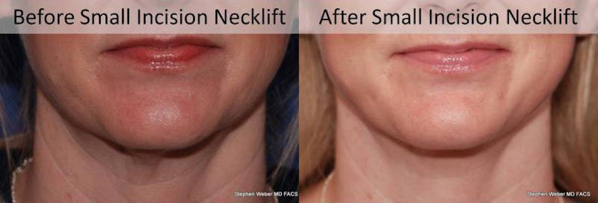 Necklift Before & After Gallery - Patient 182007 - Image 1