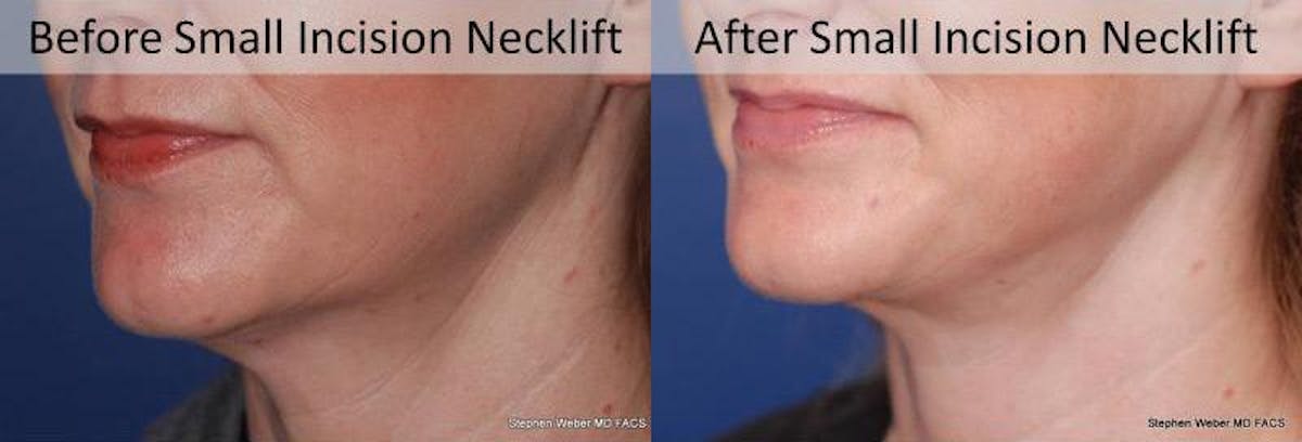 Necklift Before & After Gallery - Patient 182007 - Image 2