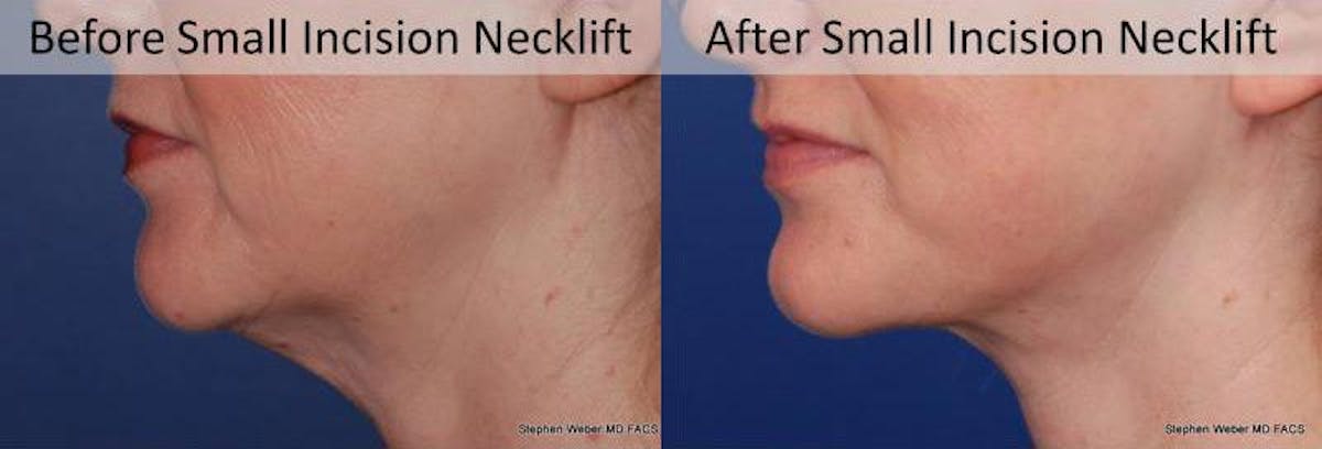 Necklift Before & After Gallery - Patient 182007 - Image 3