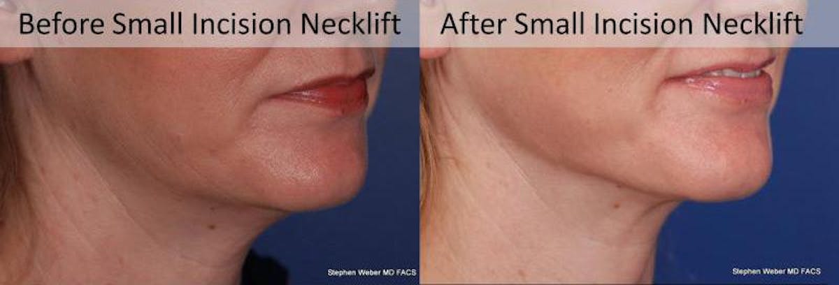 Necklift Before & After Gallery - Patient 182007 - Image 4