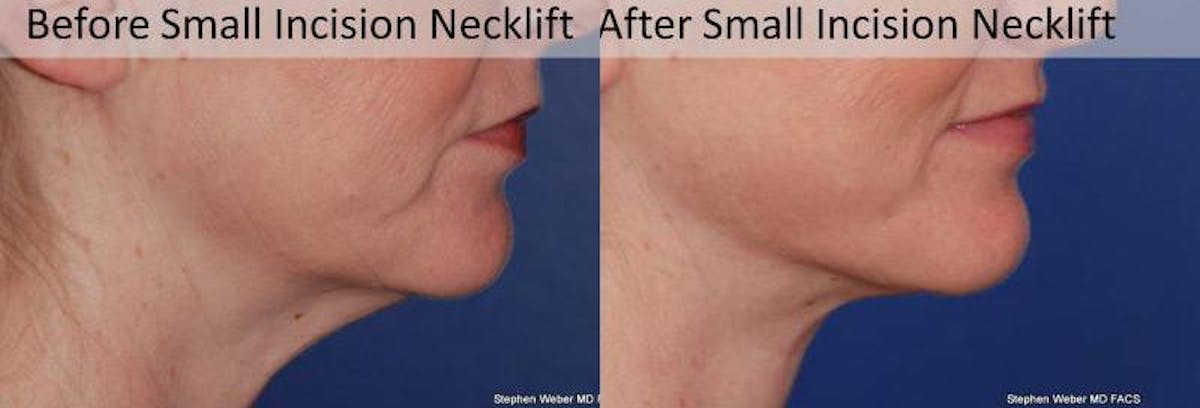 Necklift Before & After Gallery - Patient 182007 - Image 5