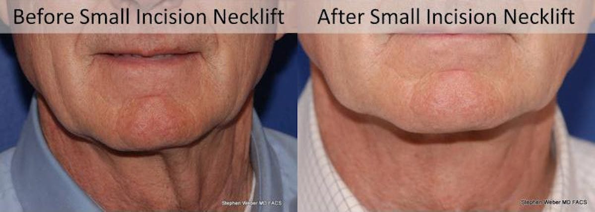 Necklift Before & After Gallery - Patient 163478 - Image 1