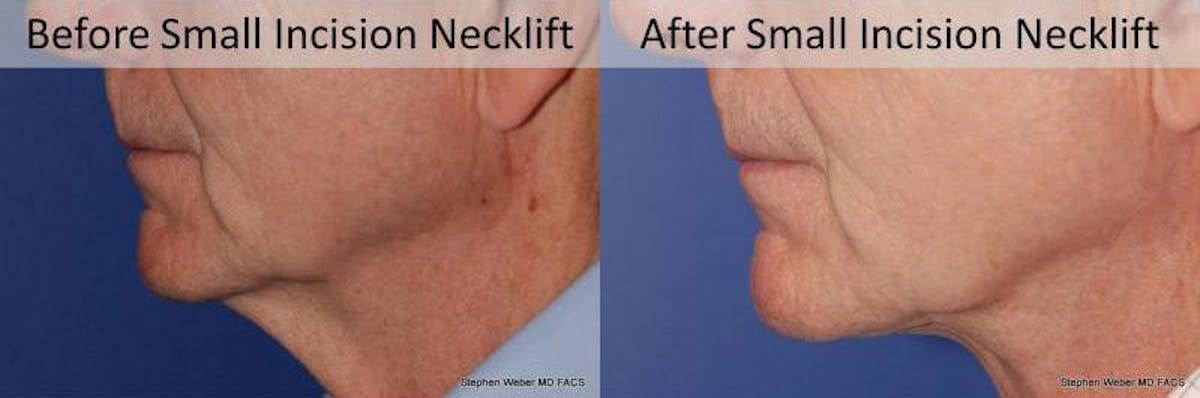 Necklift Before & After Gallery - Patient 163478 - Image 2
