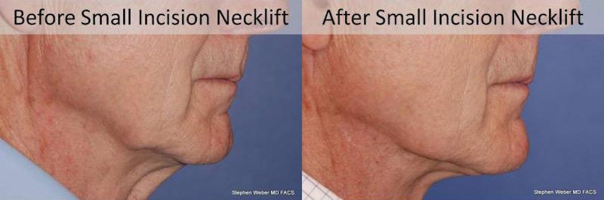 Necklift Before & After Gallery - Patient 163478 - Image 3