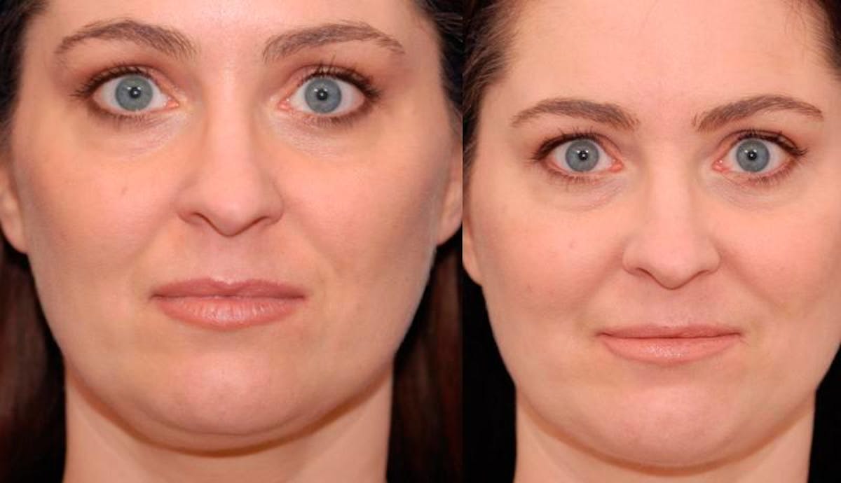 Necklift Before & After Gallery - Patient 194083 - Image 1