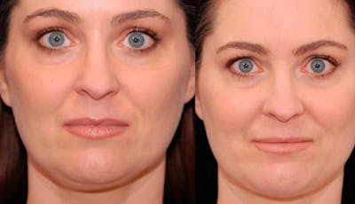 Necklift Before & After Gallery - Patient 194083 - Image 1