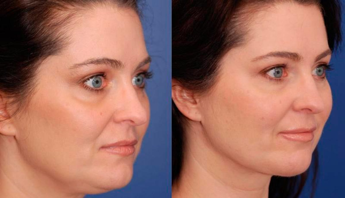 Necklift Before & After Gallery - Patient 194083 - Image 2