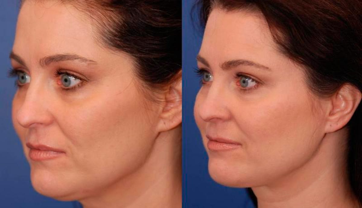 Necklift Before & After Gallery - Patient 194083 - Image 4