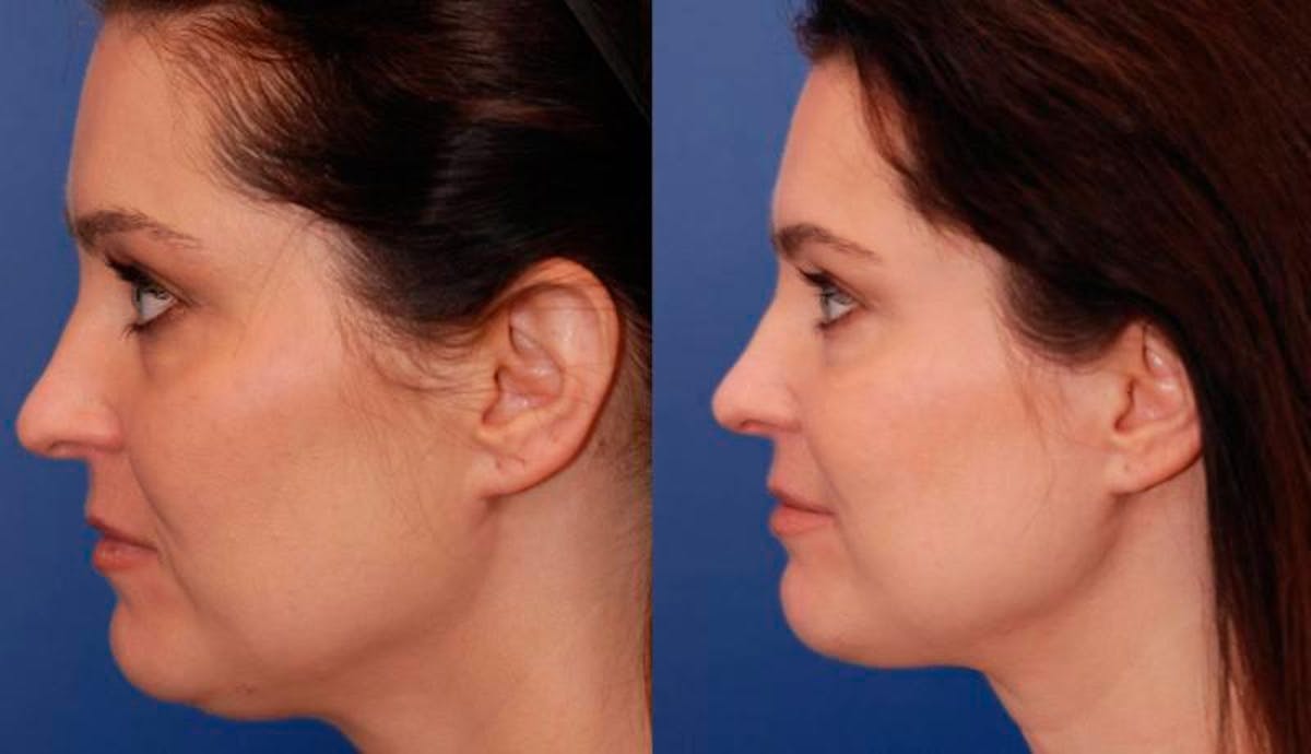 Necklift Before & After Gallery - Patient 194083 - Image 5