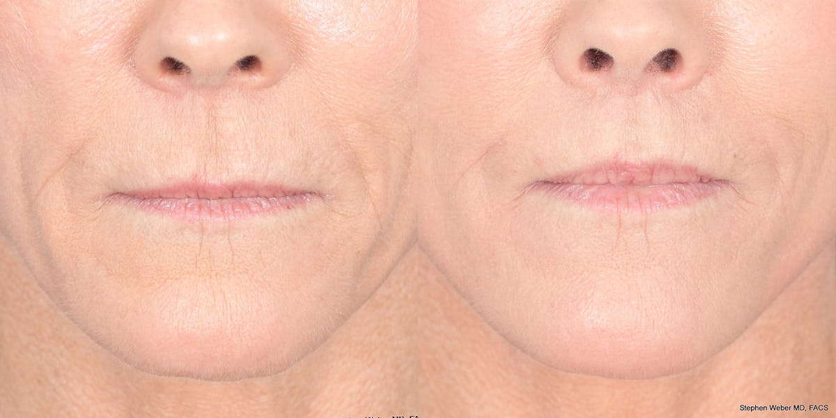 Lip Lift Before & After Gallery - Patient 548127 - Image 1