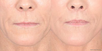 Lip Lift Before & After Gallery - Patient 548127 - Image 1
