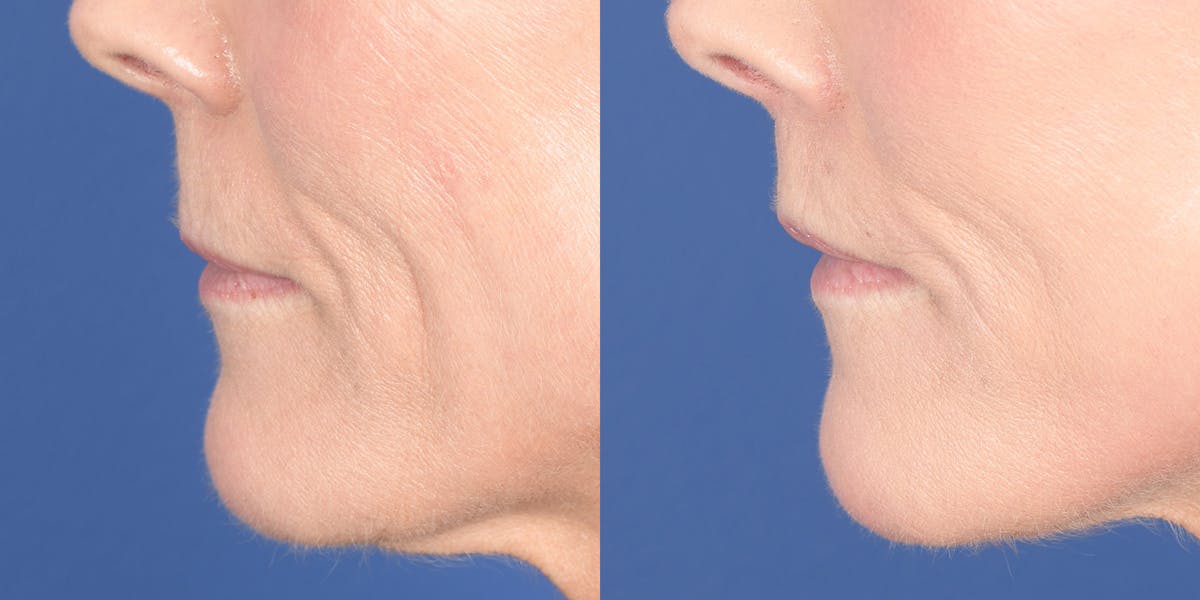 Lip Lift Before & After Gallery - Patient 548127 - Image 3