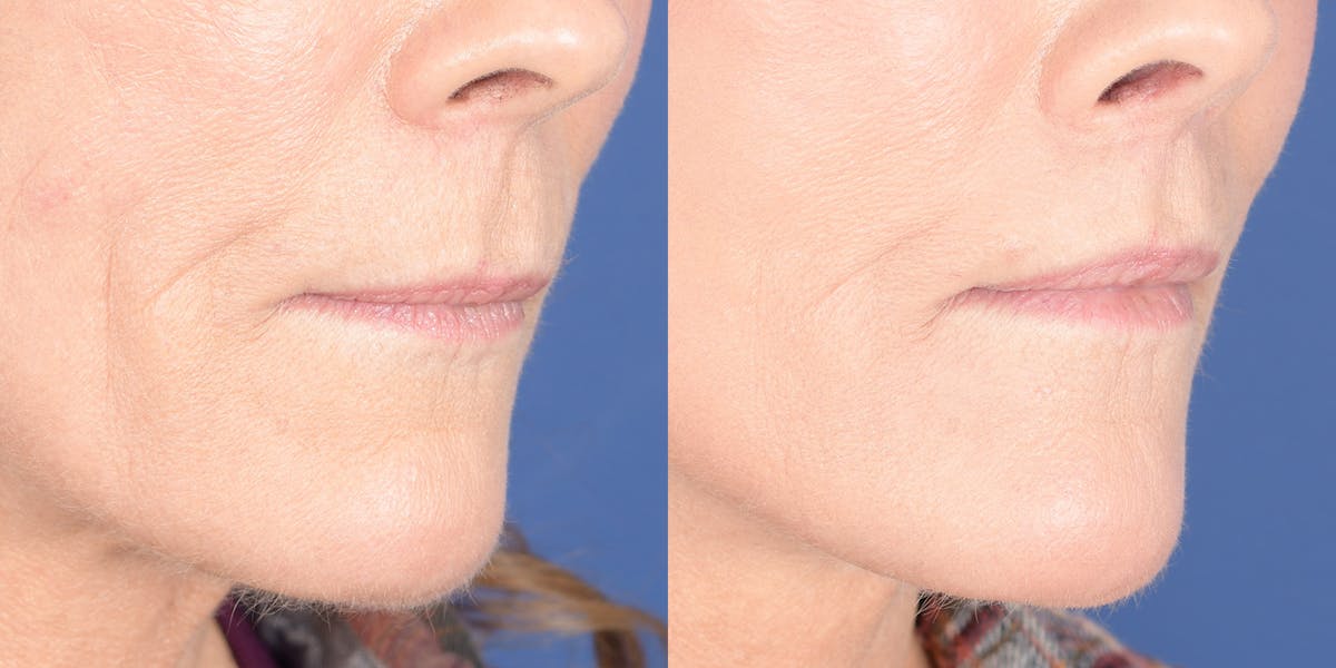 Lip Lift Before & After Gallery - Patient 548127 - Image 4