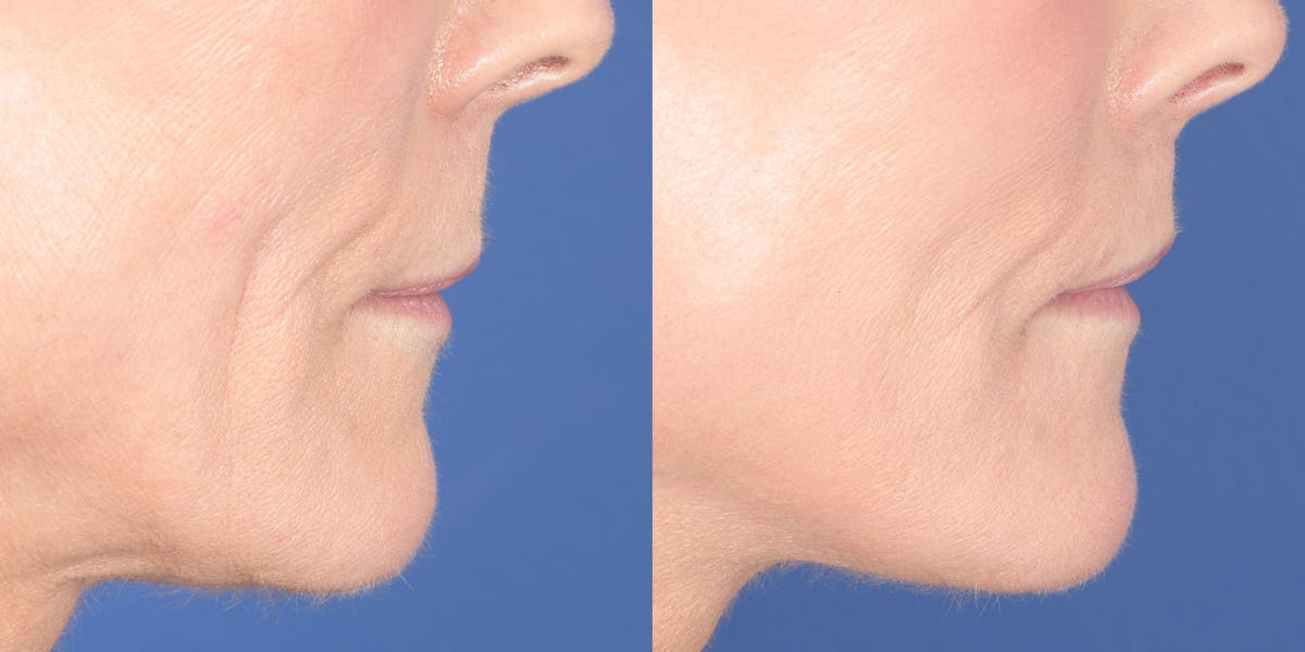 Lip Lift Before & After Gallery - Patient 548127 - Image 5