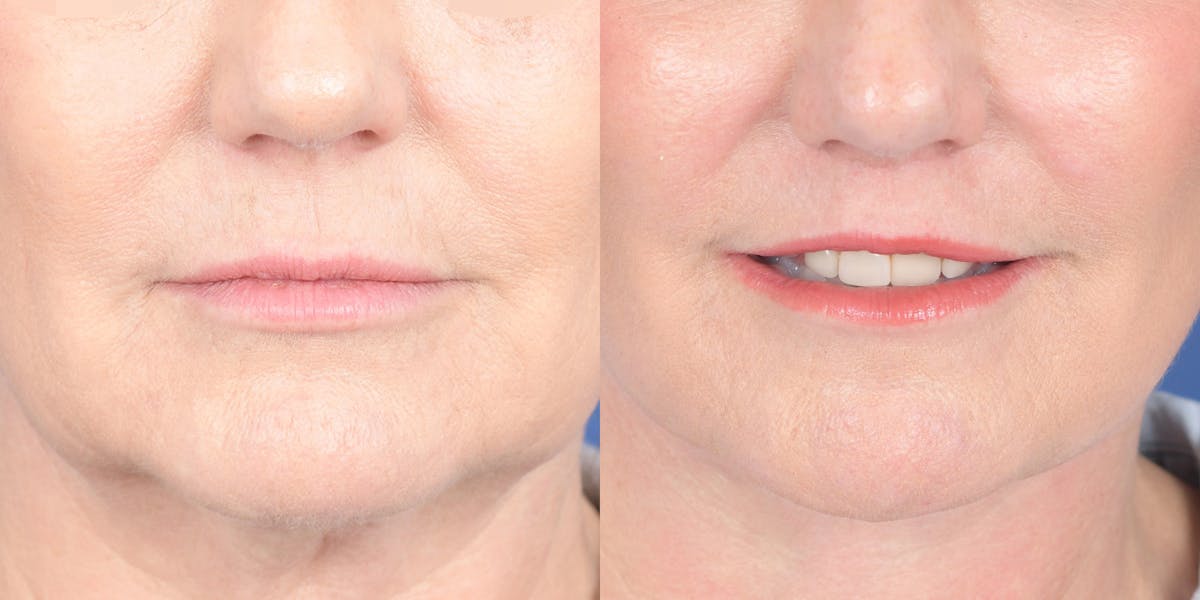 Lip Lift Before & After Gallery - Patient 336845 - Image 1