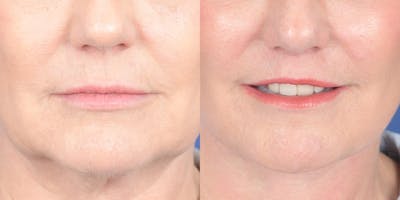 Lip Lift Before & After Gallery - Patient 336845 - Image 1