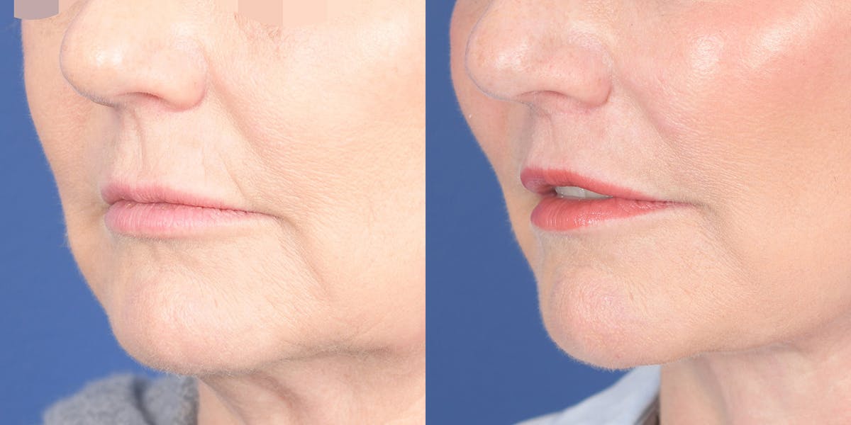 Lip Lift Before & After Gallery - Patient 336845 - Image 2