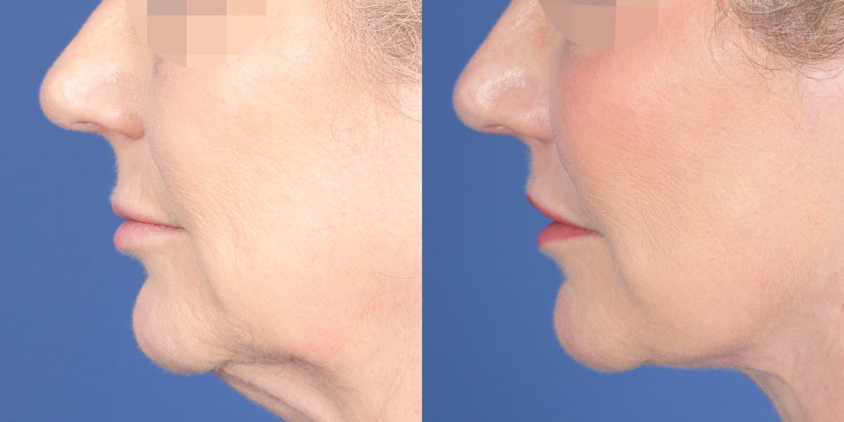 Lip Lift Before & After Gallery - Patient 336845 - Image 3