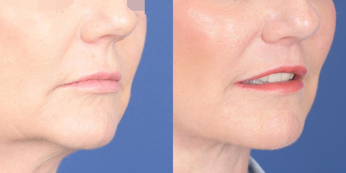 Lip Lift Before & After Gallery - Patient 336845 - Image 4