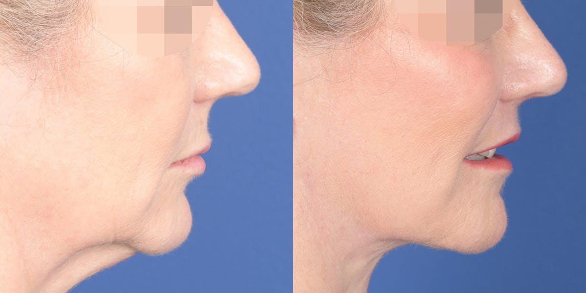 Lip Lift Before & After Gallery - Patient 336845 - Image 5