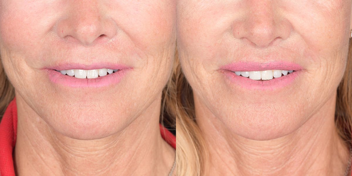 Lip Lift Before & After Gallery - Patient 219895 - Image 1