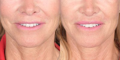 Lip Lift Before & After Gallery - Patient 219895 - Image 1