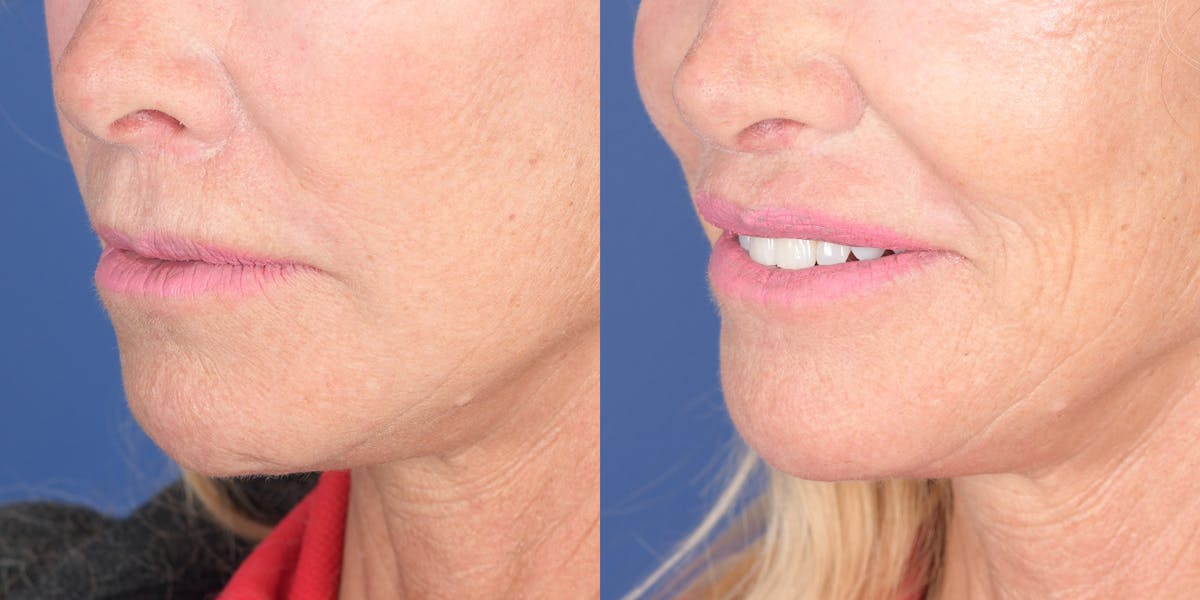 Lip Lift Before & After Gallery - Patient 219895 - Image 2