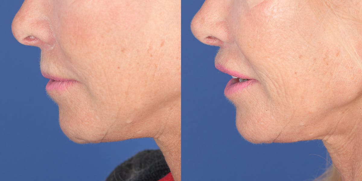 Lip Lift Before & After Gallery - Patient 219895 - Image 3