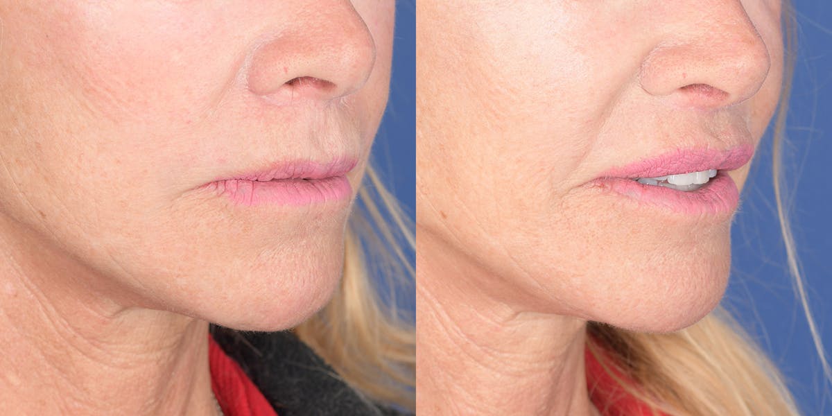 Lip Lift Before & After Gallery - Patient 219895 - Image 4