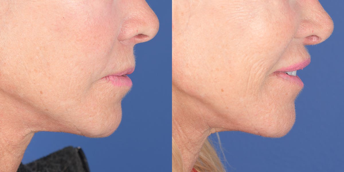 Lip Lift Before & After Gallery - Patient 219895 - Image 5