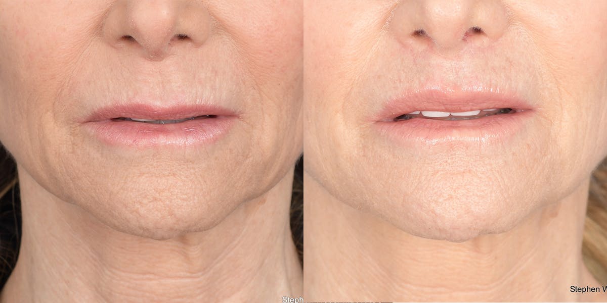 Lip Lift Before & After Gallery - Patient 973676 - Image 1