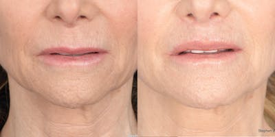 Lip Lift Before & After Gallery - Patient 973676 - Image 1
