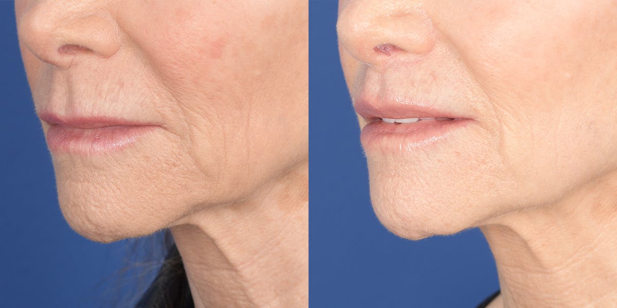 Lip Lift Before & After Gallery - Patient 973676 - Image 2