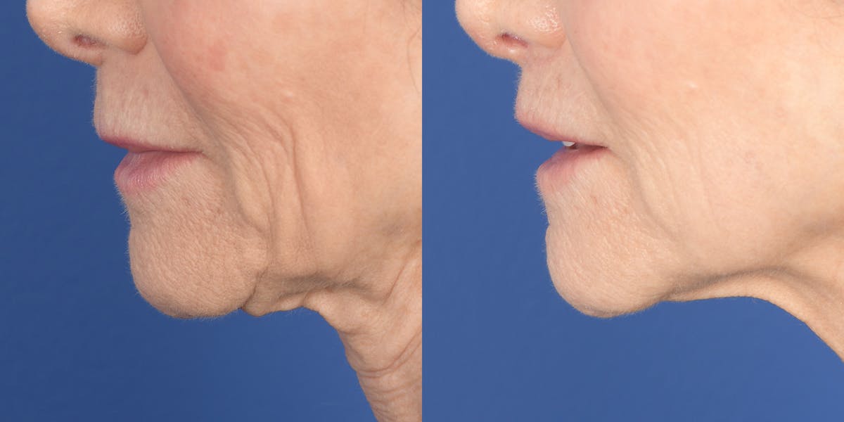 Lip Lift Before & After Gallery - Patient 973676 - Image 3