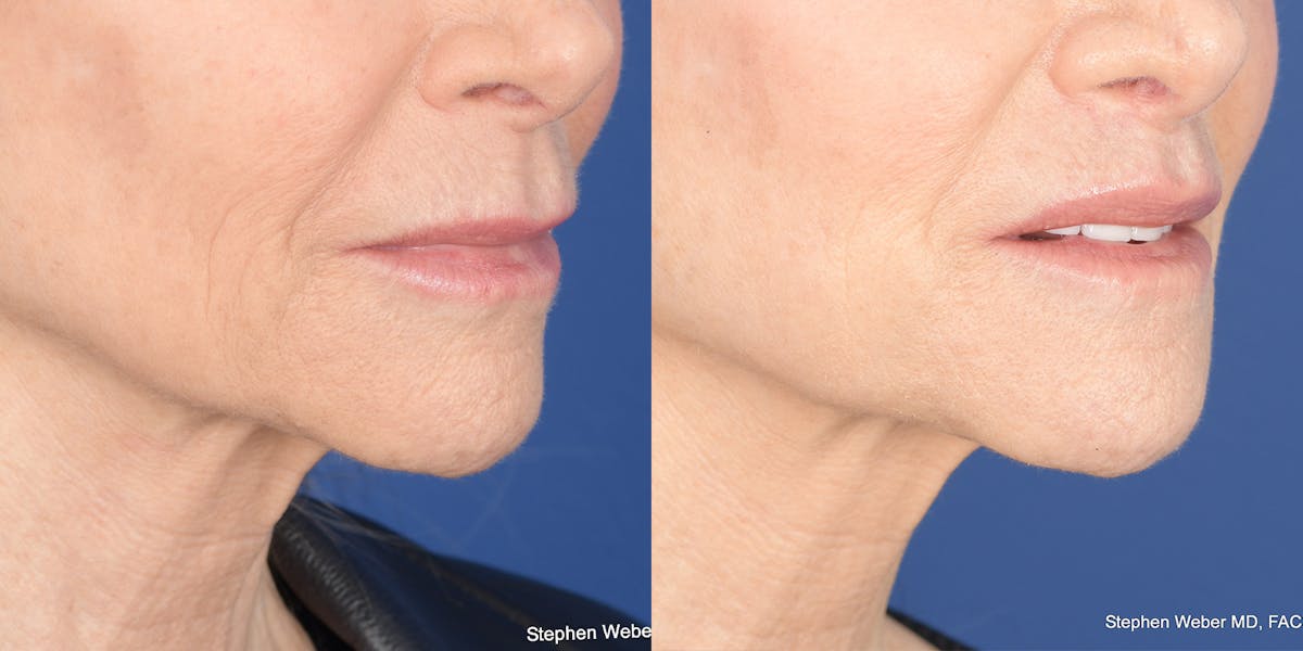 Lip Lift Before & After Gallery - Patient 973676 - Image 4
