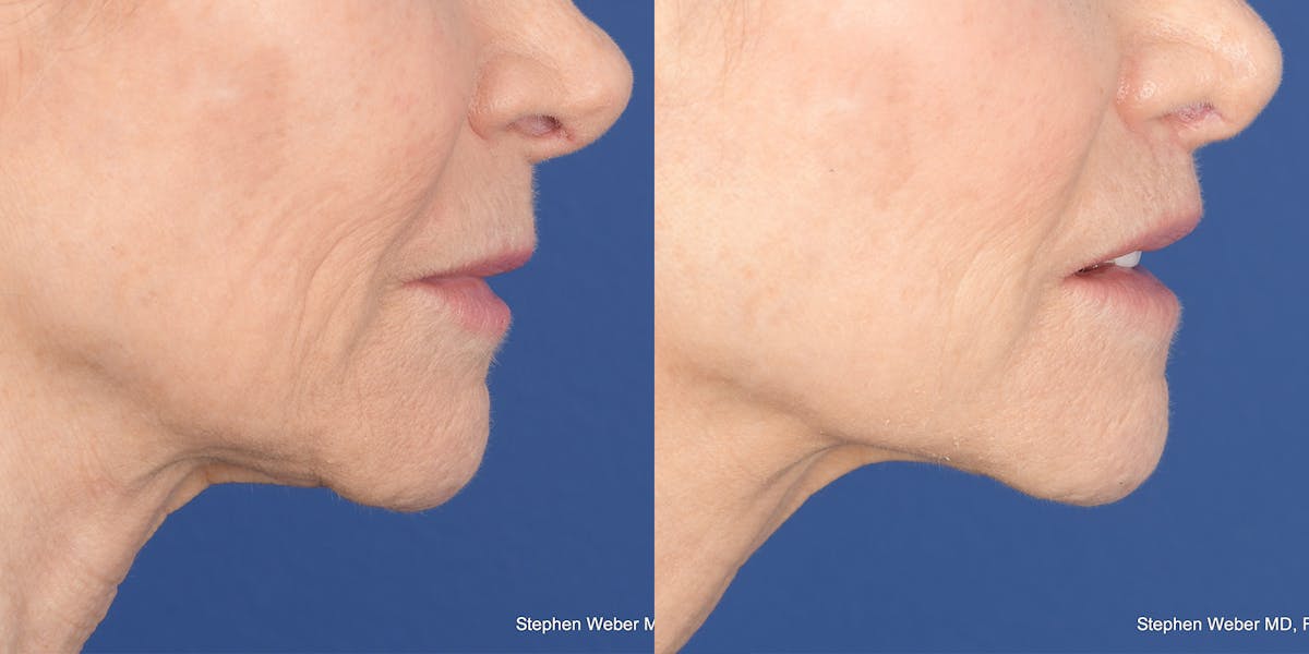 Lip Lift Before & After Gallery - Patient 973676 - Image 5