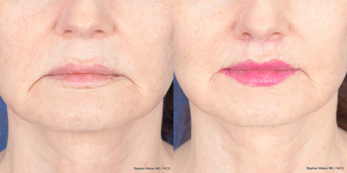 Lip Lift Before & After Gallery - Patient 365161 - Image 1