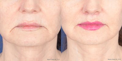 Lip Lift Before & After Gallery - Patient 365161 - Image 1