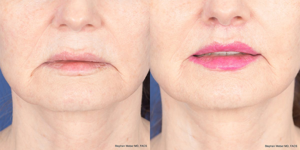 Lip Lift Before & After Gallery - Patient 365161 - Image 2
