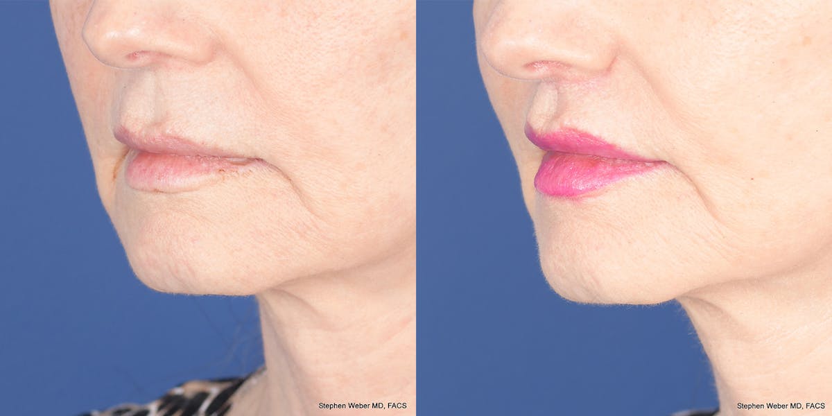 Lip Lift Before & After Gallery - Patient 365161 - Image 3