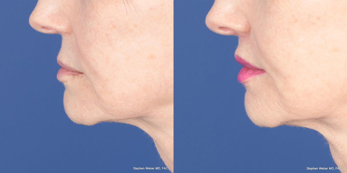 Lip Lift Before & After Gallery - Patient 365161 - Image 4