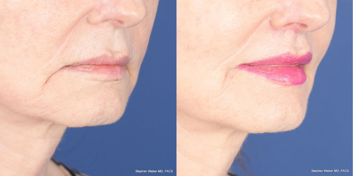 Lip Lift Before & After Gallery - Patient 365161 - Image 5