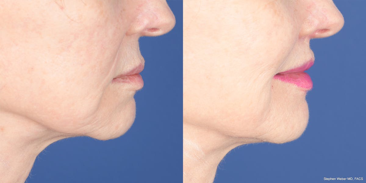 Lip Lift Before & After Gallery - Patient 365161 - Image 6