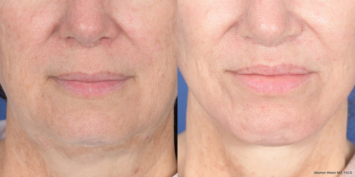 Lip Lift Before & After Gallery - Patient 110492 - Image 1
